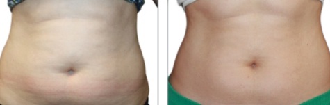 processed (1) terapia con ondas de choaque contra cellulitis abdominal Reus