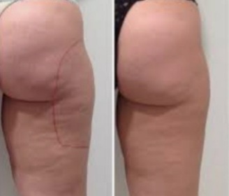 processed tratamientos anticelulitis